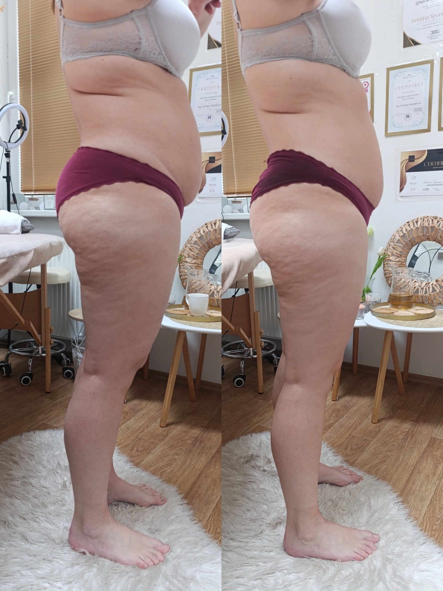 Lymfomodeling vrchnej časti tela